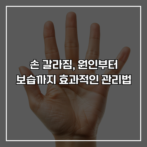 손 갈라짐, 원인부터 보습까지 효과적인 관리법